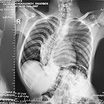 Felç Riski Taşıyan Kırgız Genç Şifayı Türkiye'de Buldu