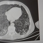 KOAH ve Zatürre Tehlikesi: Uzmanından Kritik Uyarılar