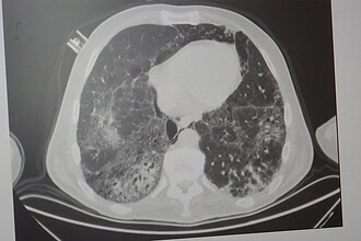 KOAH ve Zatürre Tehlikesi: Uzmanından Kritik Uyarılar