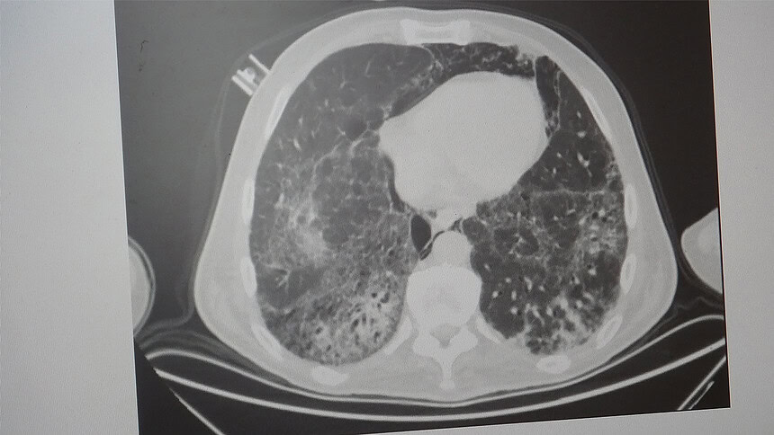 KOAH ve Zatürre Tehlikesi: Uzmanından Kritik Uyarılar