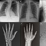 Yapay zekâ şimdi de sahte röntgen üretti: Üstelik bazı radyologlar da ilk bakışta ayırt edemedi!