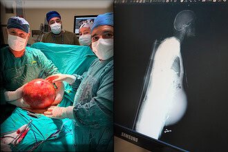 Doktorlar Şoke Oldu: 74 Yaşındaki Hastanın Karnından 6,5 Kiloluk Dev Kitle Çıktı!