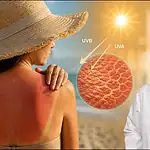 Çocukluktaki Ağır Güneş Yanığı Melanom Riskini İki Kat Artırıyor