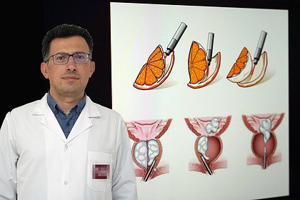 İyi Huylu Prostat Büyümesine HoLEP Yöntemi İle Kapalı Çözüm!